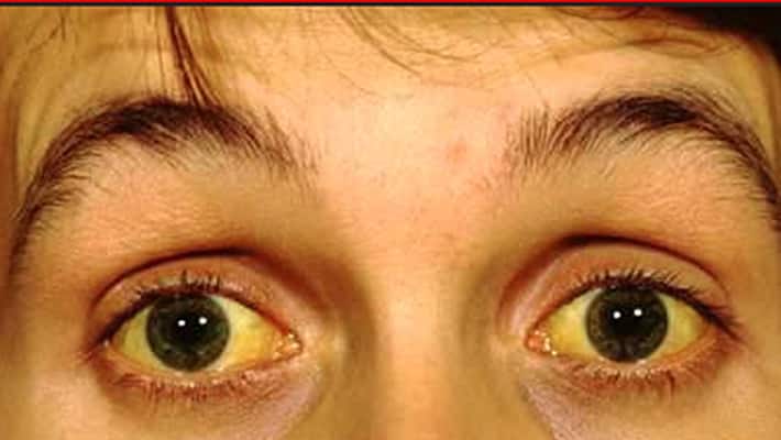 Precautions of jaundice Precautions of jaundice