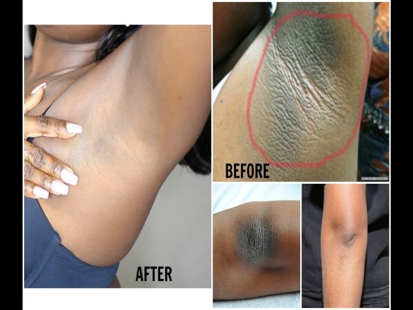 Best and easy Home remedies for dark underarm