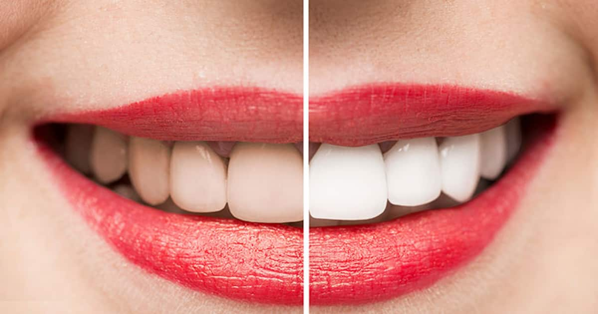 5 teeth-whitening hacks that you can do at home