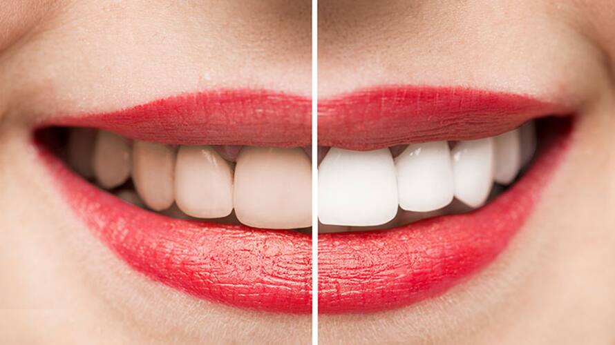 5 teethwhitening hacks that you can do at home