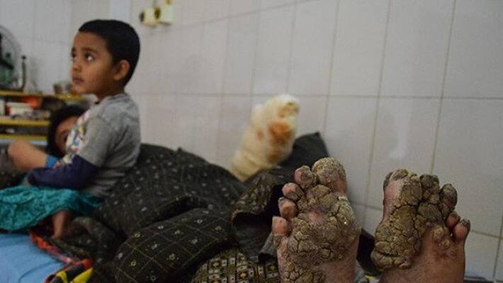 After 24 surgeries Bangladesh tree man relapses After 24 surgeries Bangladesh tree man relapses