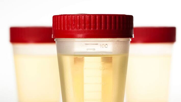 Your urine says about your health Your urine says about your health