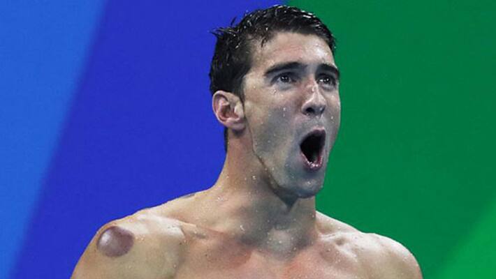 So, what are those marks on Michael Phelps' body? So, what are those marks on Michael Phelps' body?