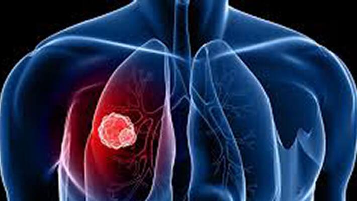 Foods to Reduce the Risk of Lung Cancer Foods to Reduce the Risk of Lung Cancer