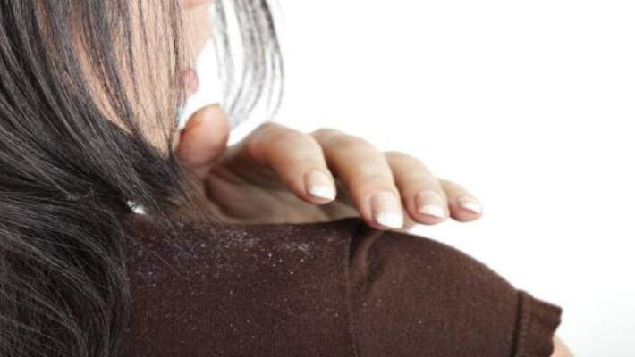 home remedies for Treat dandruff home remedies for Treat dandruff